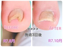 巻き爪ケアセンター 横須賀の雰囲気(爪を傷つけないように優しい刺激で少しづつ形を整えていきます。)