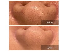 毛穴の詰まりや汚れもスッキリ