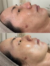 シェアリー(sharely..)/お肌の糖化にも！