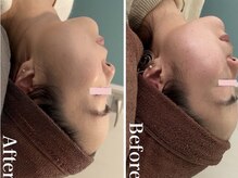 ルビー(Ruby)/【20代】ニキビ悩み・1回