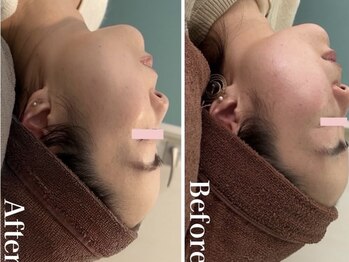 ルビー(Ruby)/【20代】ニキビ悩み・1回