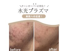 大人気水光プラズマは、ニキビケア、潤いケア、エイジングにも◎