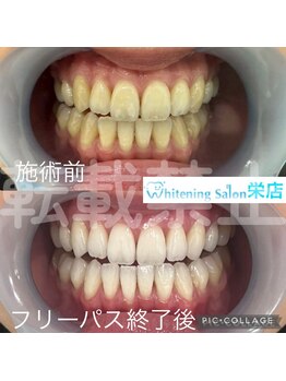 ホワイトニングサロン 名古屋 栄店/【ホワイトニング】