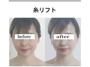 ラピリカ(LA PRICA)の写真/40代以降のシワ、たるみ、ほうれい線改善!小顔糸リフト!