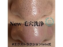 ブリノス(BLINOSS)/毛穴エクストラクションtete式