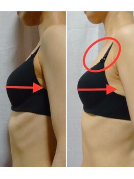 ベッピン(Beppin)/バストアップ症例写真