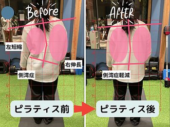 ファクト(fact)/側湾でお悩みの方の変化した例