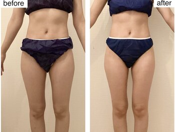 ルシエル ハカタ(Luciel HAKATA)/痩身120分×2回(20代)※膝位置