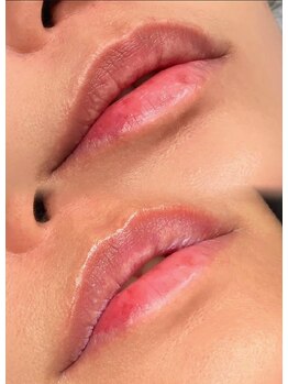 ライム 新宿西口(LIME)/ローマピンク|黒ずみケア