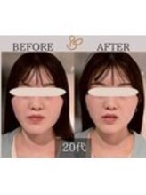 チョコバリ 錦糸町店(chocobari)/小顔×リフトアップ(美容鍼)20代