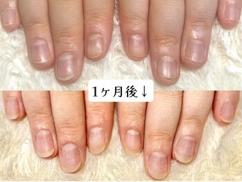 グラシナ なんば店/深爪/自爪育成/フィルイン