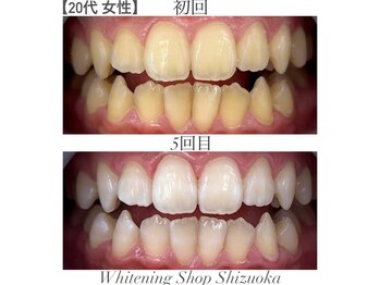 ホワイトニングショップ 静岡店/ホワイトニングBefore→After