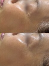 ソレラ(sorelle)/目元のシワ