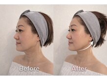 メルティーズ 東京 麻布十番(MELTY's)/オンダリフトビフォーアフター