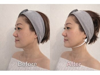 メルティーズ 東京 麻布十番(MELTY's)/オンダリフトビフォーアフター