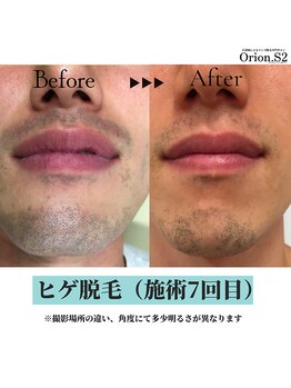 オリオンドットエスツー(Orion.S2)/【Before→After】