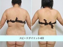 リクラ(Reclat)/スピードダイエット4回