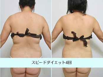 リクラ(Reclat)/スピードダイエット4回