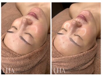 まつげエクステ専門店 ヴィーナスラッシュ 自由が丘店(Venus Lash)の写真/韓国で話題沸騰【ララピール】導入！次世代ピーリングで、韓国女優のような白玉ツヤ肌に♪