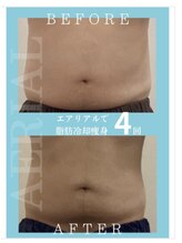 エアリアル 八代店/男性の脂肪冷却！ビール腹改善！