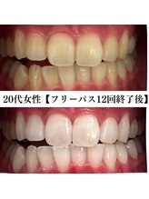ホワイト 福岡天神店(WHITE)/ホワイトニングビフォーアフター