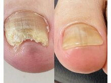 シーネイル(C Nail)/肥厚して伸びない！お悩み改善