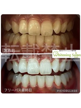 ホワイトニングサロン 広島店/【ホワイトニング施術例】