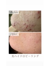アリュール(ALLURE)/光ハイドロピーリング施術効果