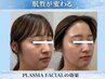 プラズマフェイシャル/お肌悩み全般に【毛穴/くすみ/たるみ/美白/ニキビ】