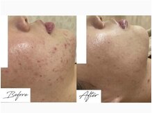 【Q＆A】何回でキレイになりますか？肌状態によりますが、6回以降で改善される方が多いです。