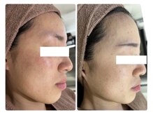 ホワイトアクア 北千住店(WHITE AQUA)/ハーブピーリング/肌質改善/毛穴