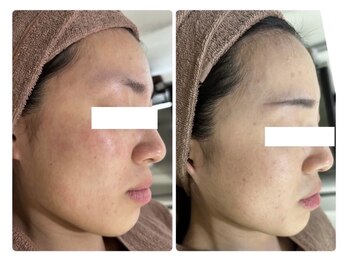 ホワイトアクア 北千住店(WHITE AQUA)/ハーブピーリング/肌質改善/毛穴