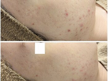 アン(anne)/剥離なしハーバルメソッド×６回