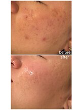 マイルーチェ 可児川合店(MyLuce)/肌質改善