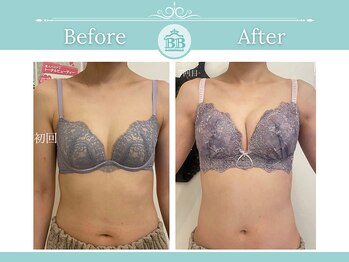 美人バスト 福岡店/バストアップ◇症例◇