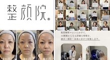 【小顔リフト】肌質改善 整顔院 経堂店