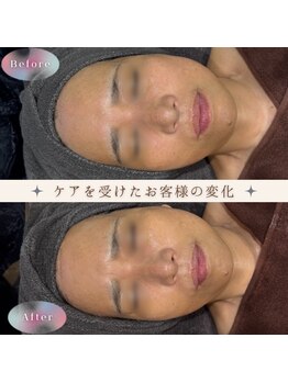 美肌研究所 絹 田辺店/1度の”ゾンビマスク”肌弾力UP!