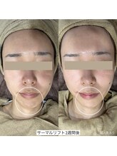 ダリア(Dahlia)/食いしばり★サーマルリフト