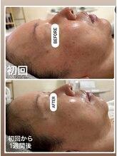 ジャスミン(Jasmin)/プラペン×幹細胞