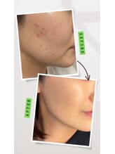 ビユー エスティカ オリエンタル 伊勢崎店(BIYU ESTETICA ORIENTAL)/ハブピーリング