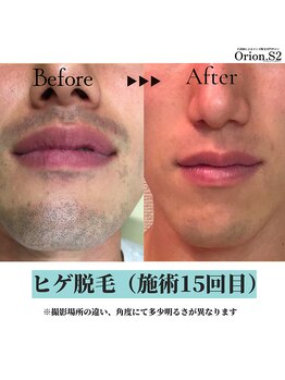 オリオンドットエスツー(Orion.S2)/【Before→After】