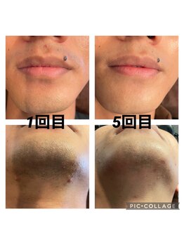 サクロス(Sacloth)/20代前半 3回～5回で印象up