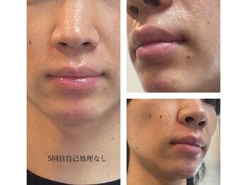 テンピスモ(tempismo)/before after