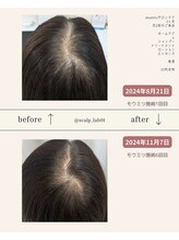 スカルプラボ(Scalp Lab)/moumitu3ヶ月症例