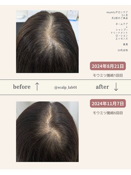 スカルプラボ(Scalp Lab)/moumitu3ヶ月症例