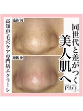 エクラーレ(Eclale)/【毛穴ケア】症例