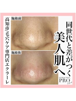 エクラーレ(Eclale)/【毛穴ケア】症例