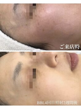 ホッコリ 段原店(HOKKORI)/効果実感No.1BBL光フェイシャル