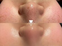 肌育効果美容液成分入り！【毛穴洗浄】うる艶陶器肌へ★全顔ハイドラフェイシャル(美容液成分入)5500円