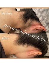 カシェット(cachette)/うなじ脱毛